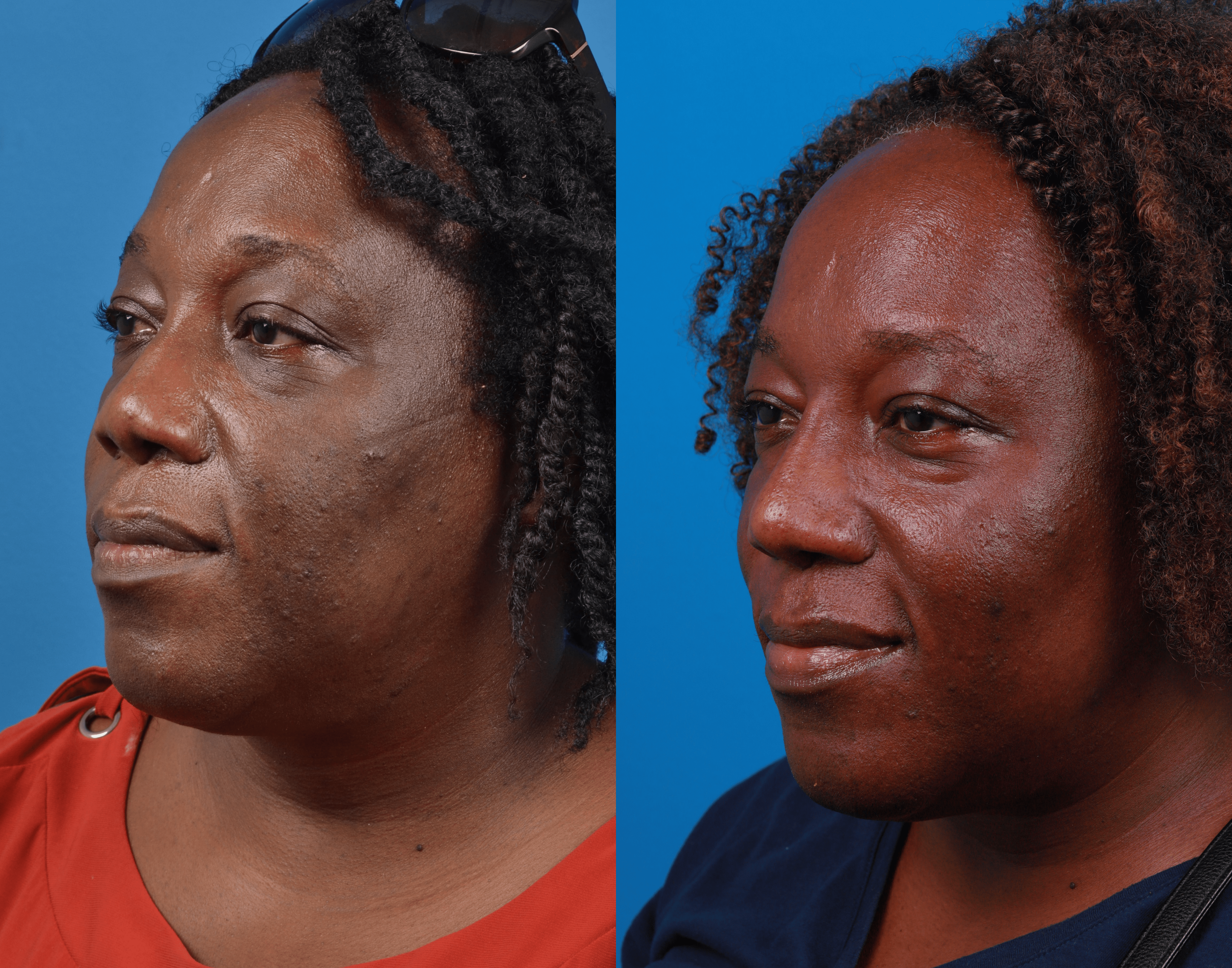 Rhinoplasty Before & After Gallery - Patient 122406972 - Image 2