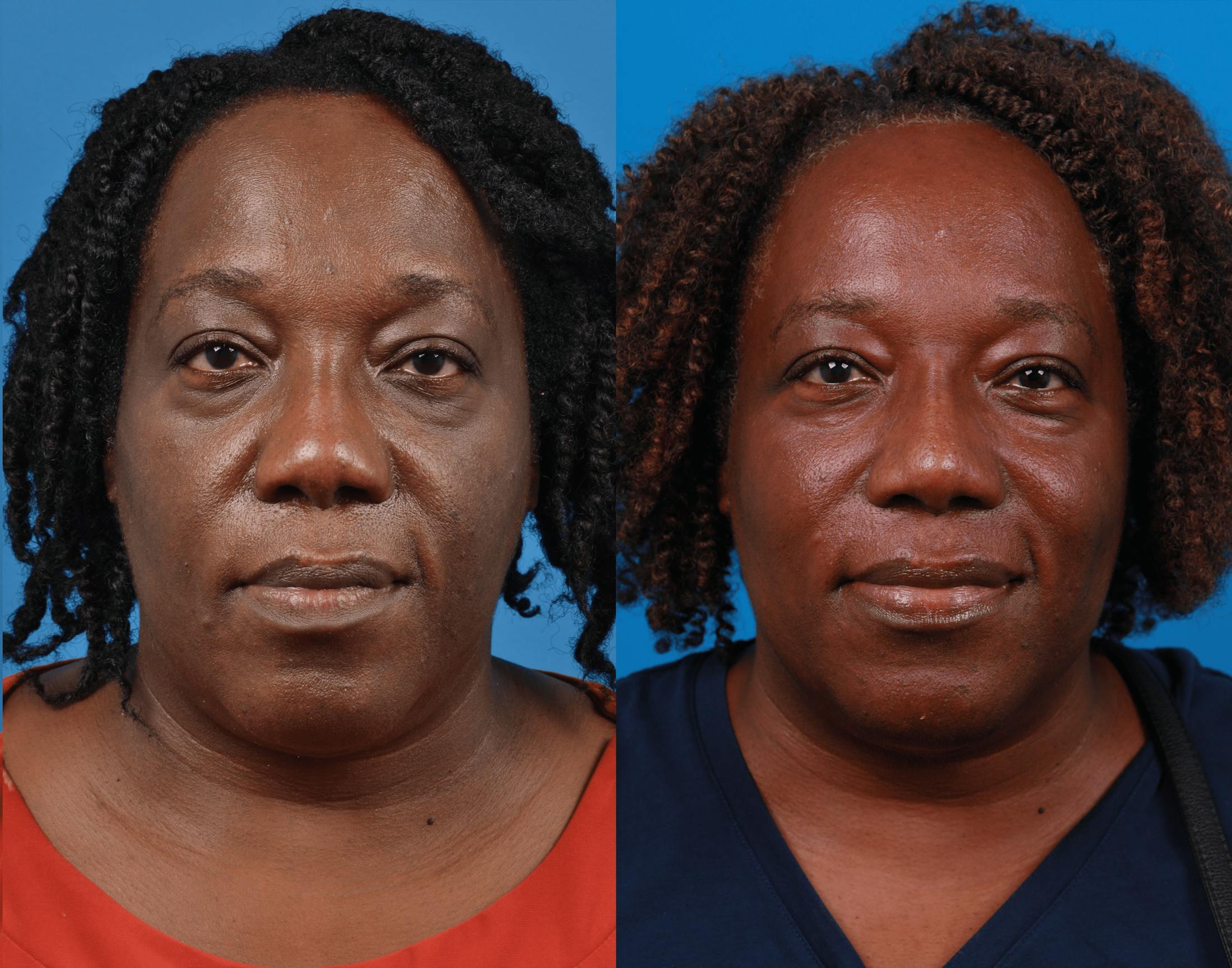 Rhinoplasty Before & After Gallery - Patient 122406972 - Image 3