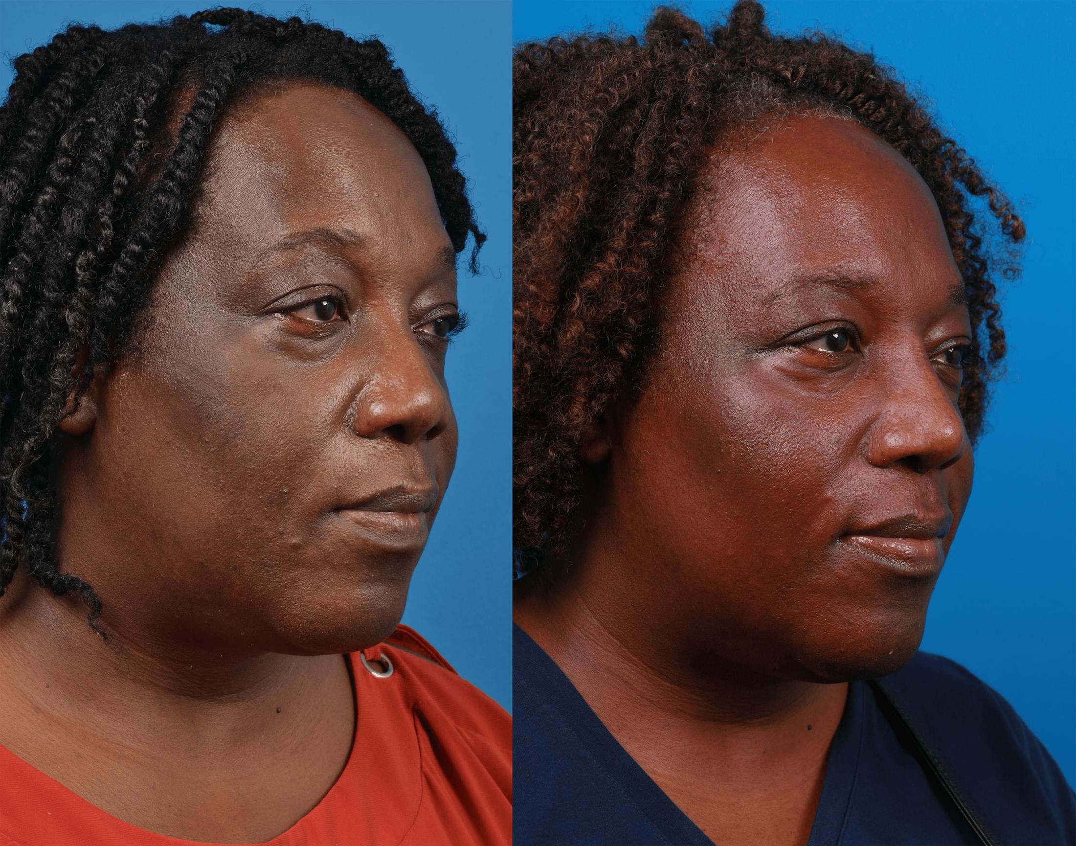 Rhinoplasty Before & After Gallery - Patient 122406972 - Image 4