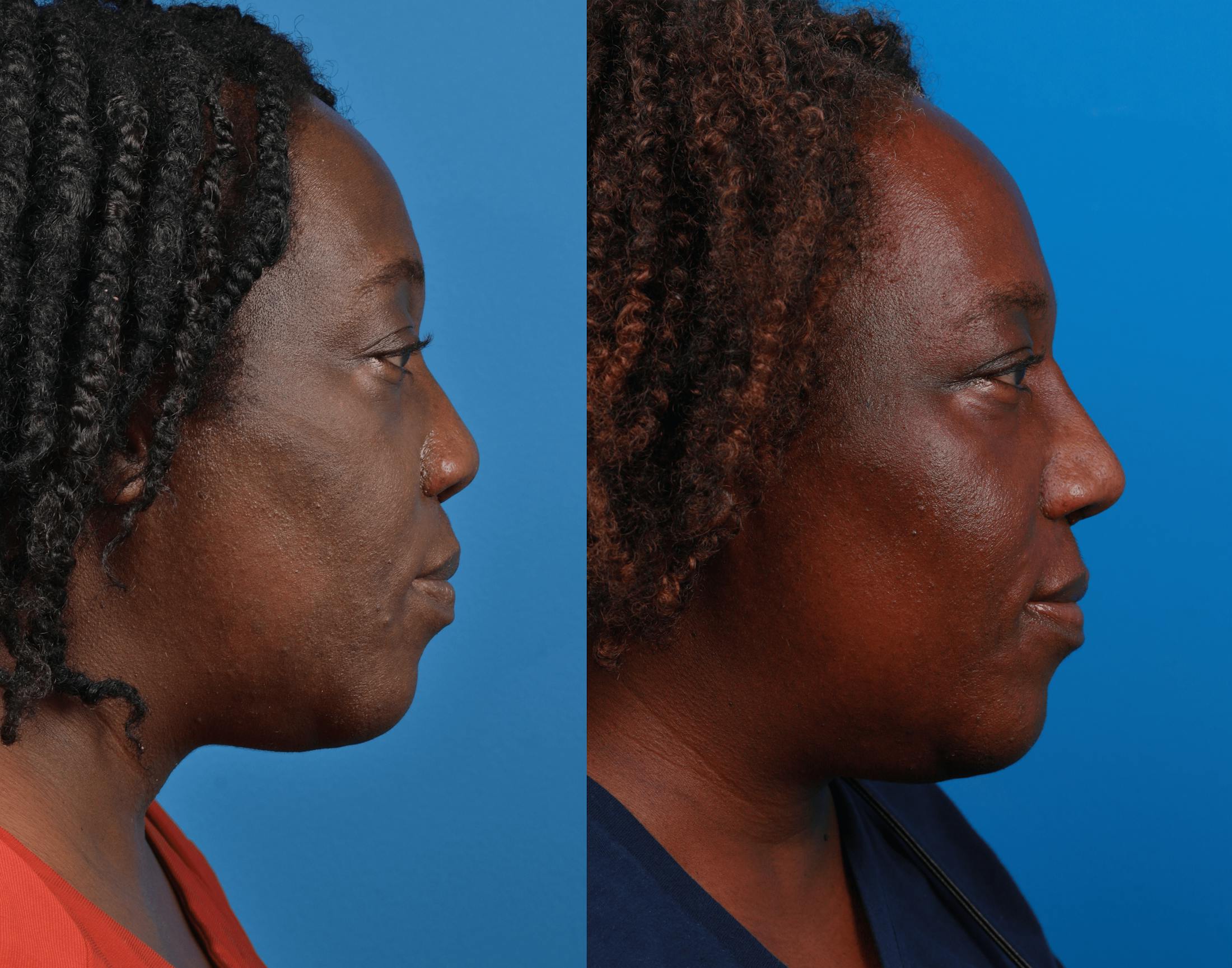 Rhinoplasty Before & After Gallery - Patient 122406972 - Image 5