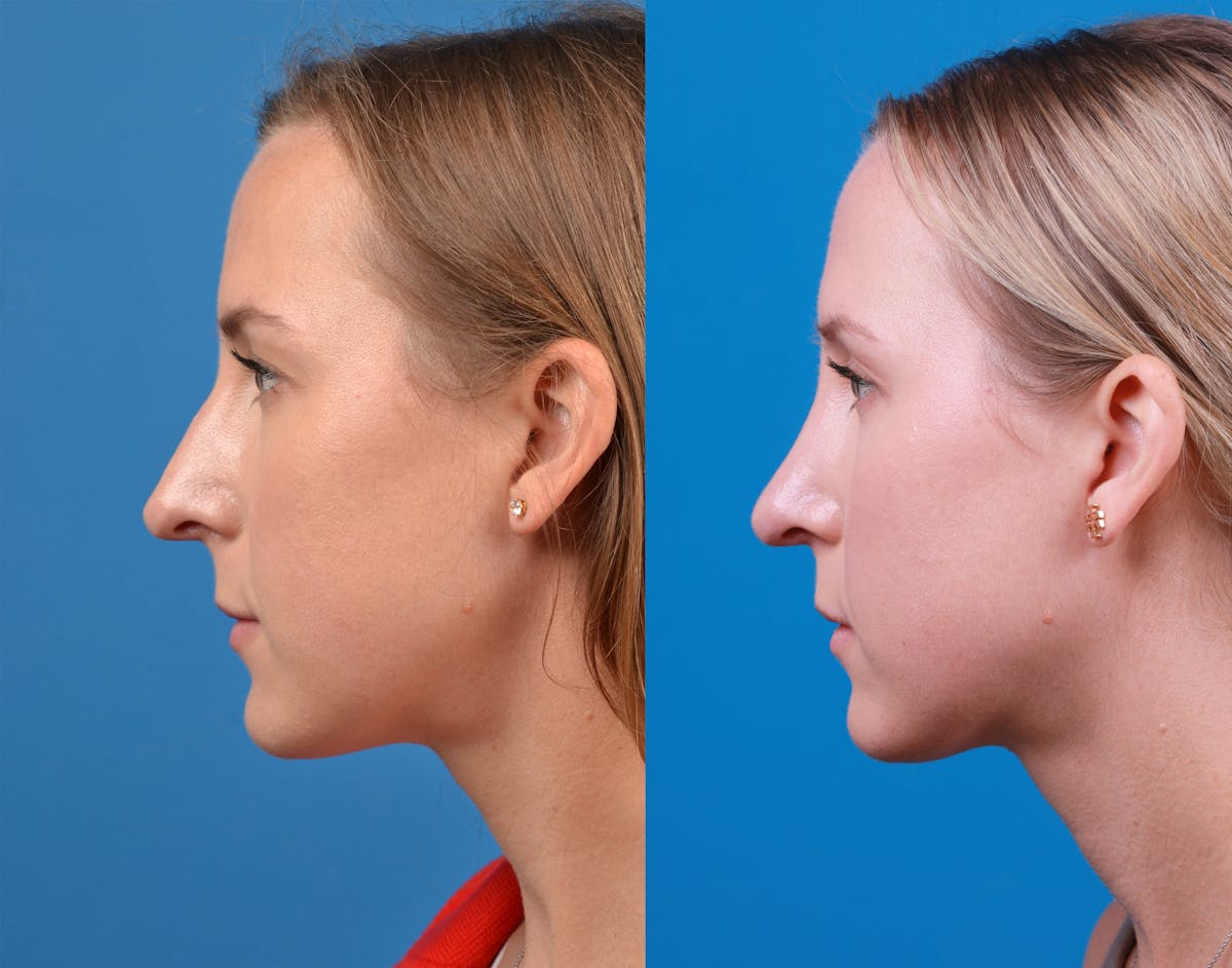 Rhinoplasty Before & After Gallery - Patient 122406974 - Image 1