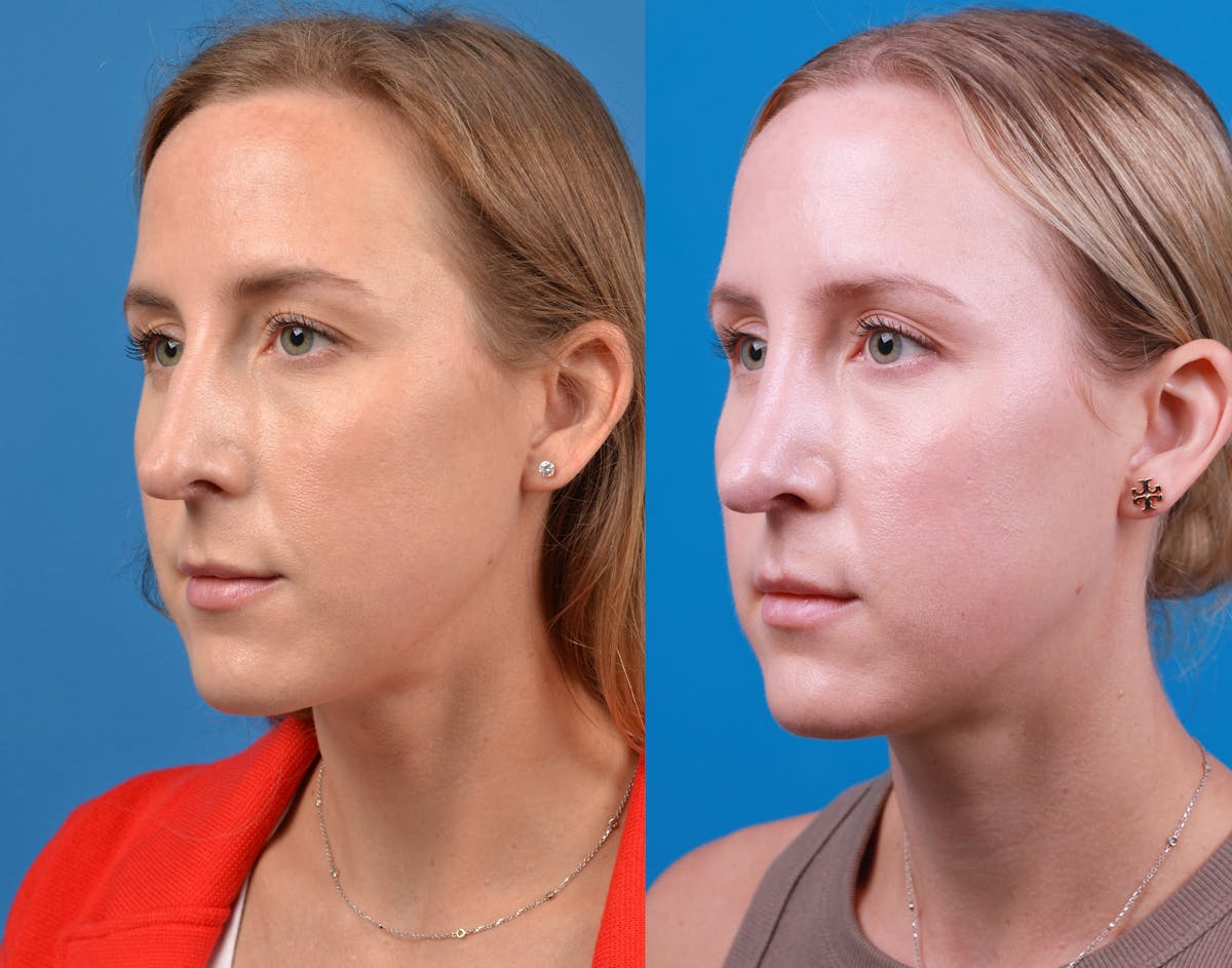 Rhinoplasty Before & After Gallery - Patient 122406974 - Image 2