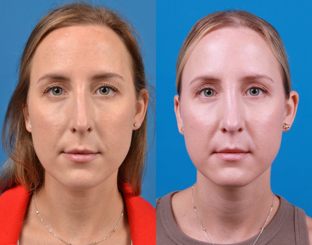Rhinoplasty Before & After Gallery - Patient 122406974 - Image 3