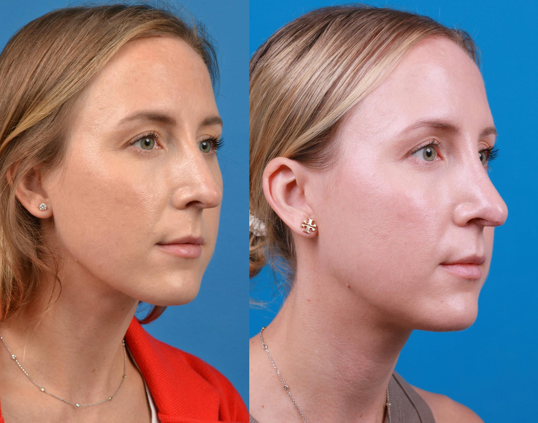 Rhinoplasty Before & After Gallery - Patient 122406974 - Image 4
