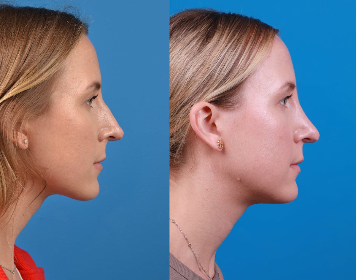 Rhinoplasty Before & After Gallery - Patient 122406974 - Image 5