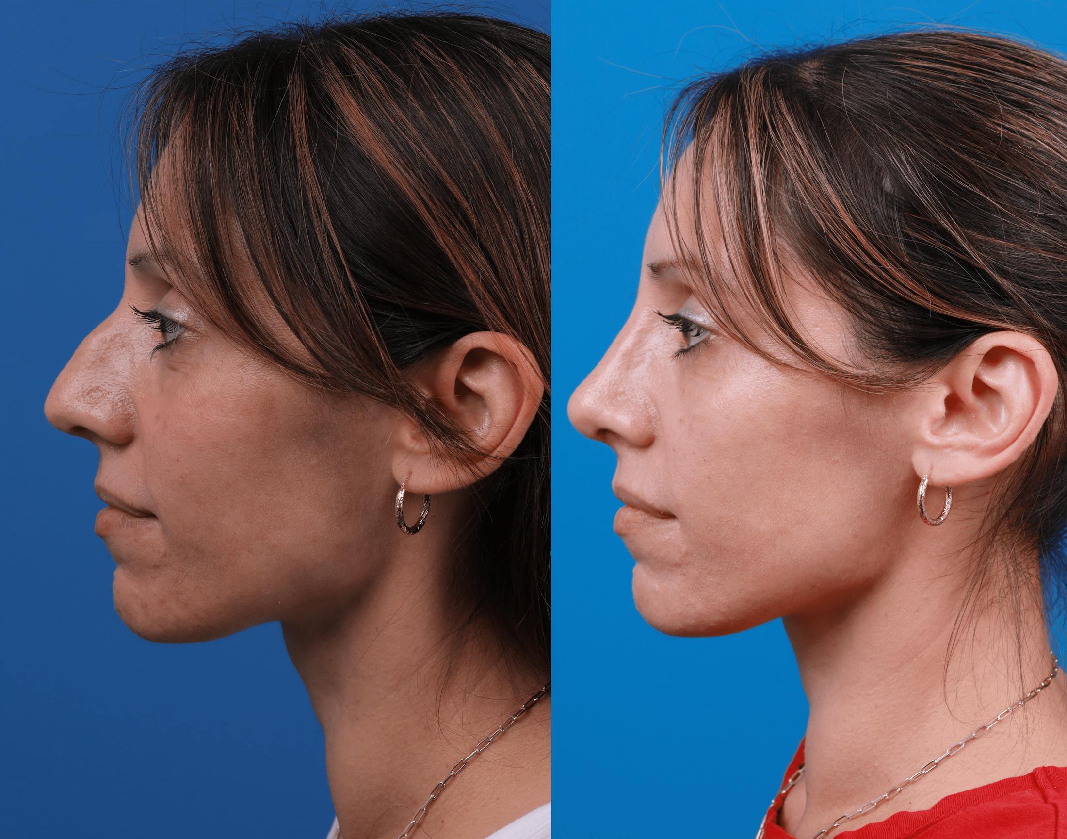 Rhinoplasty Before & After Gallery - Patient 122406978 - Image 1