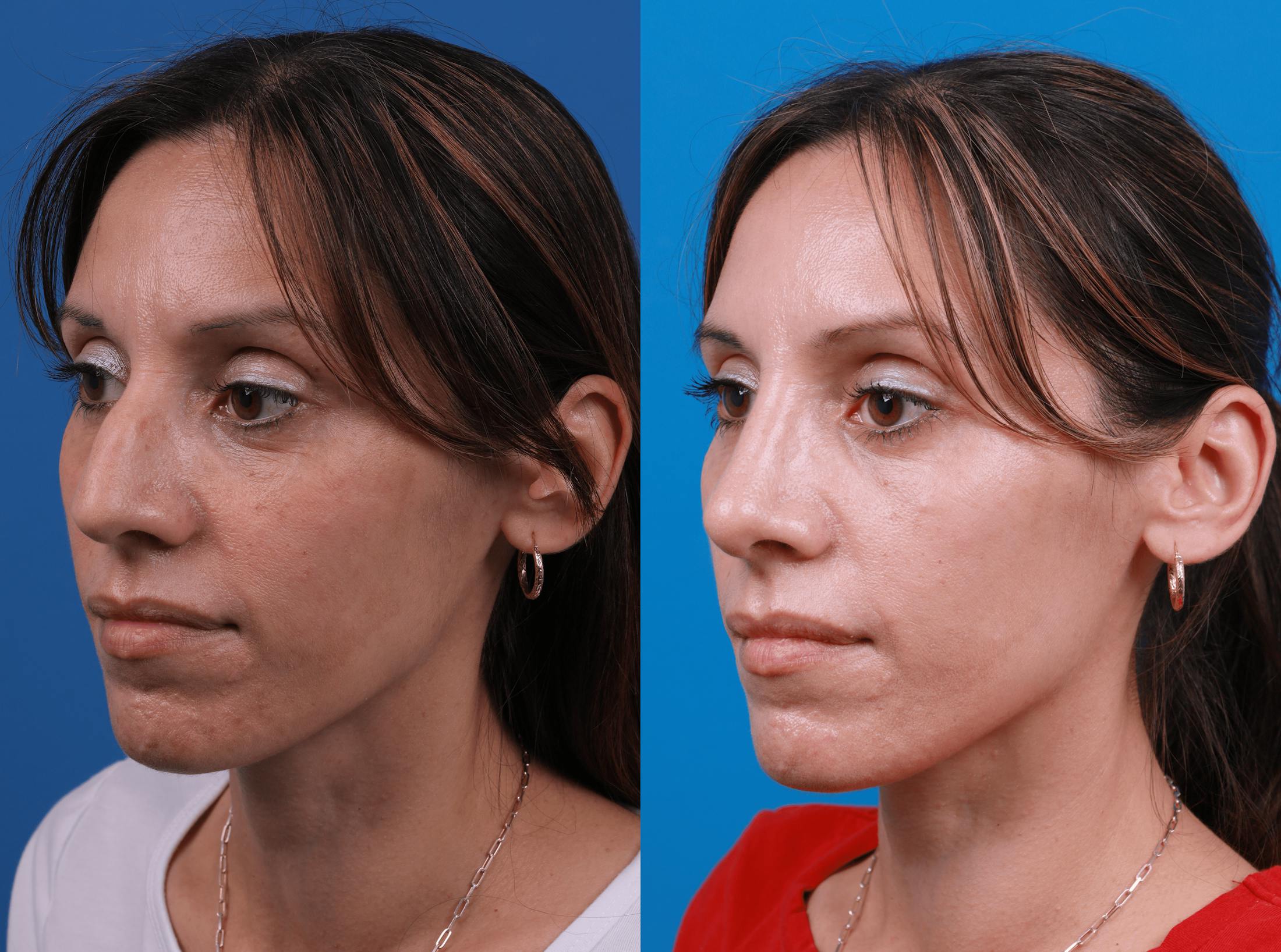 Rhinoplasty Before & After Gallery - Patient 122406978 - Image 2