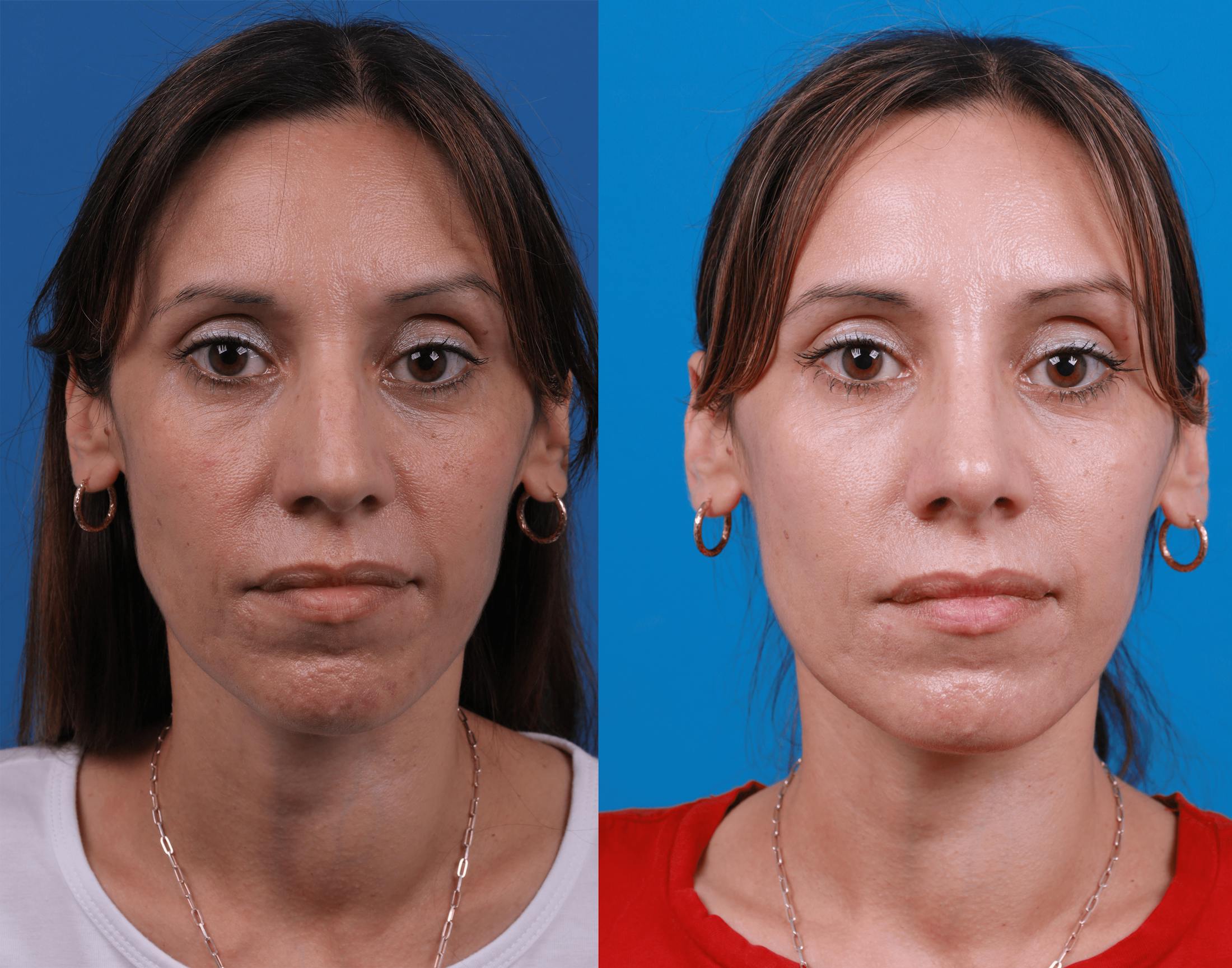 Rhinoplasty Before & After Gallery - Patient 122406978 - Image 3