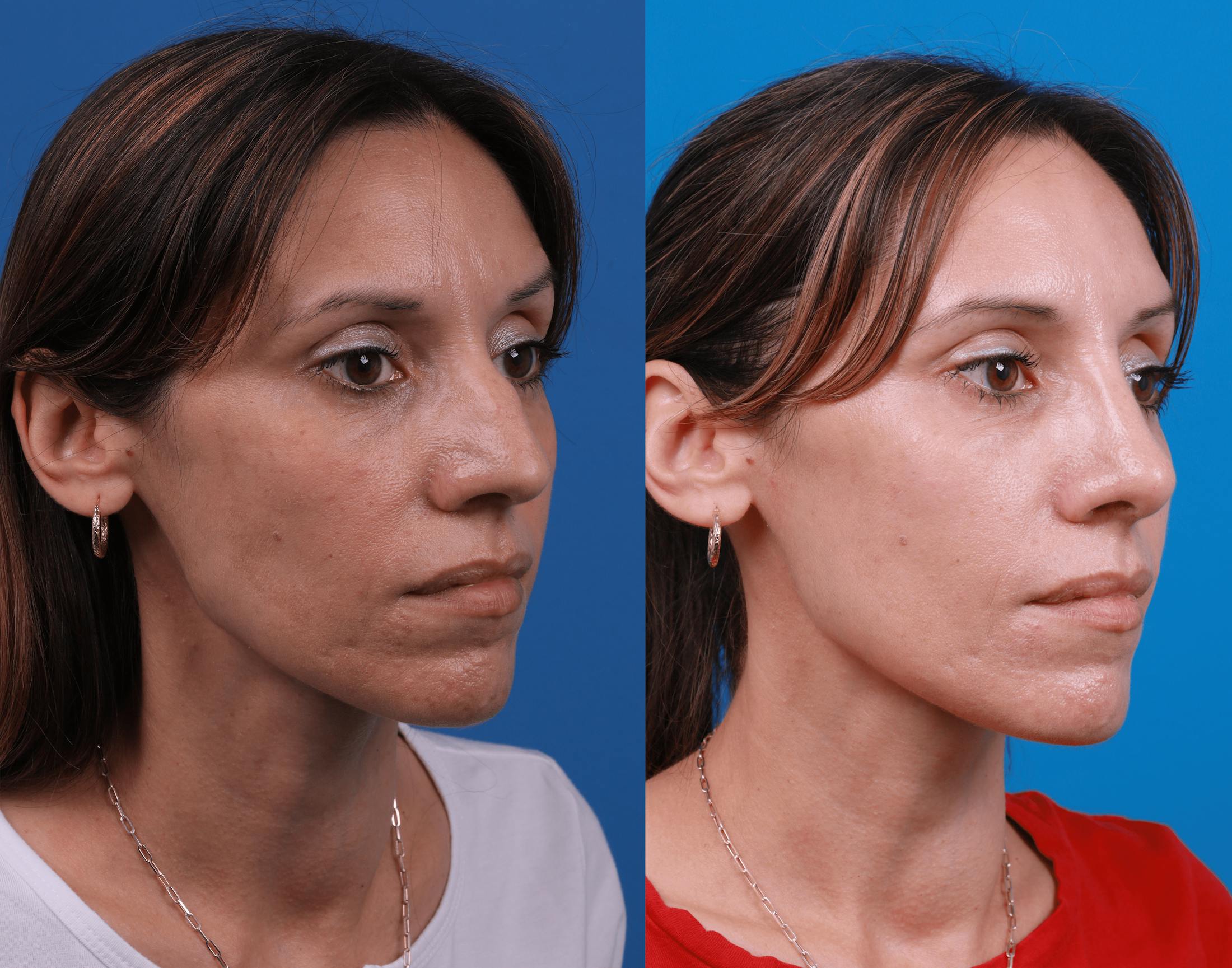 Rhinoplasty Before & After Gallery - Patient 122406978 - Image 4