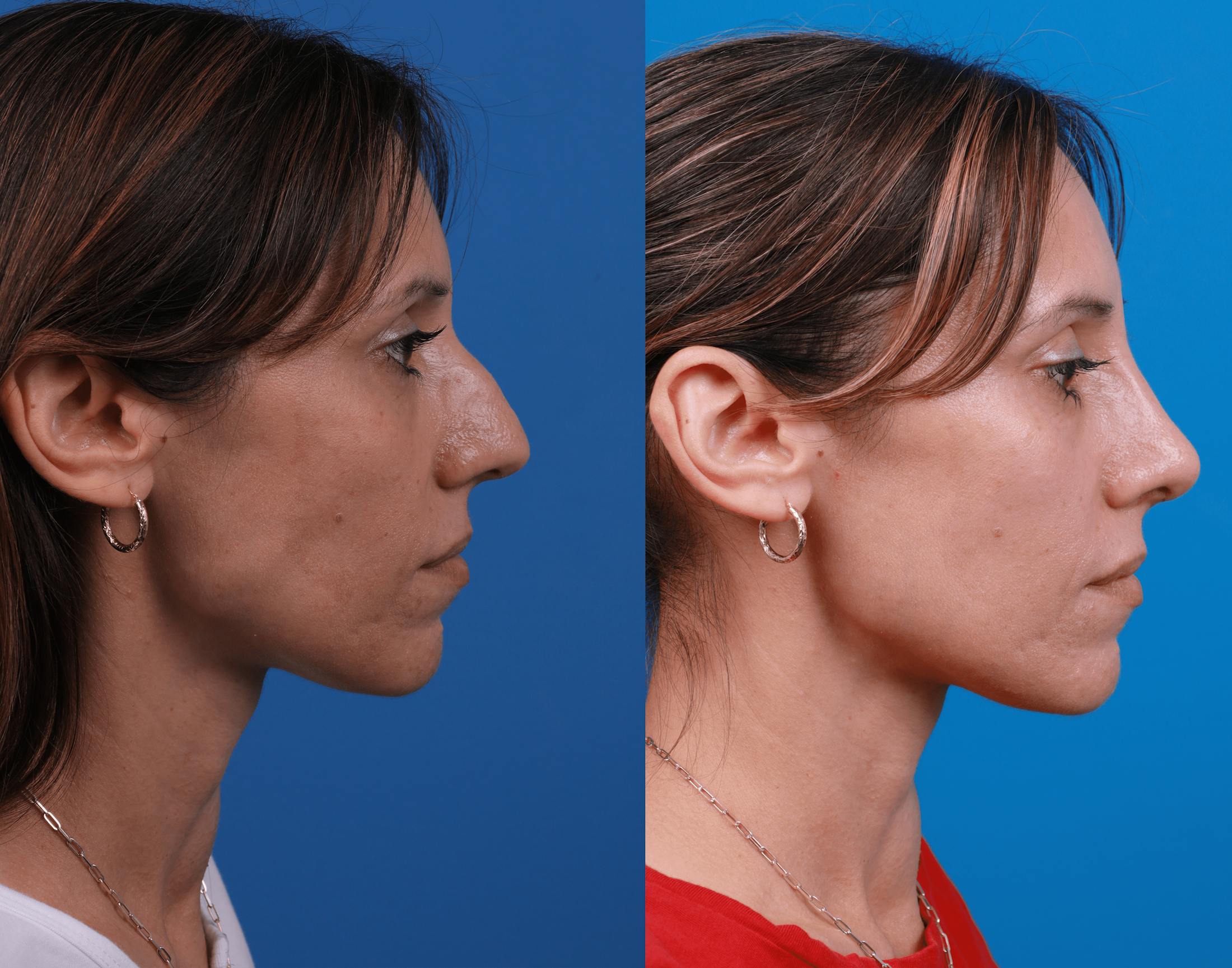 Rhinoplasty Before & After Gallery - Patient 122406978 - Image 5
