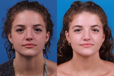 Rhinoplasty Before & After Gallery - Patient 122406979 - Image 1