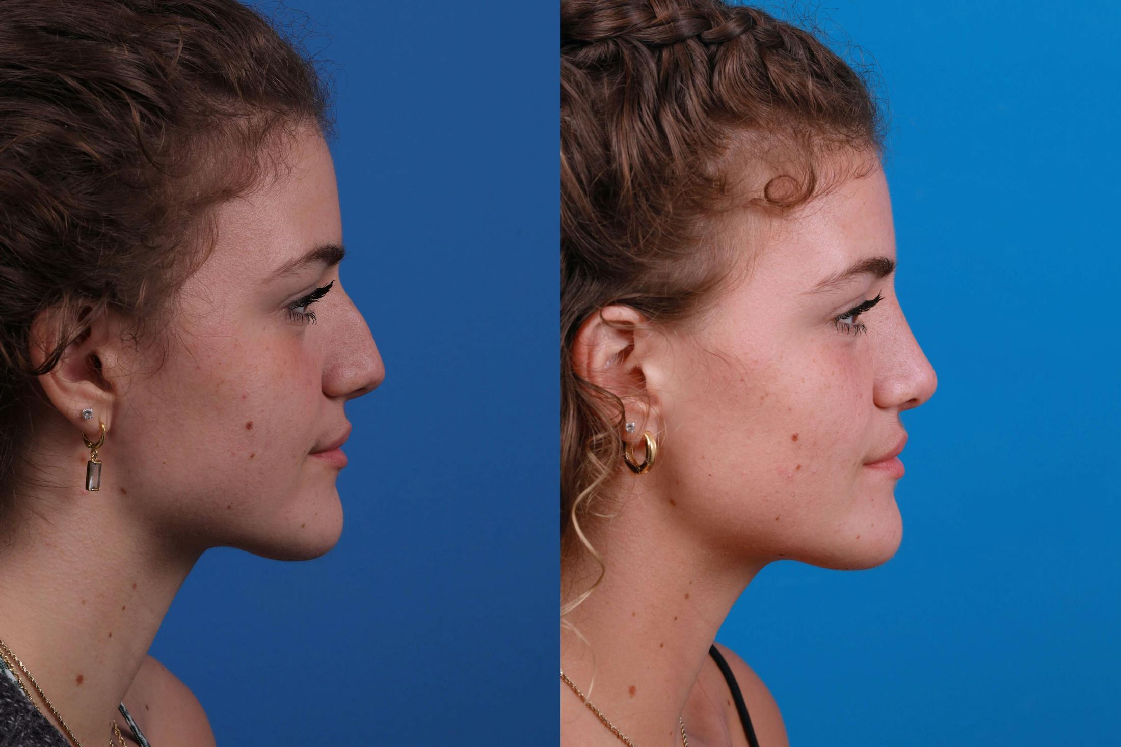 Rhinoplasty Before & After Gallery - Patient 122406979 - Image 2