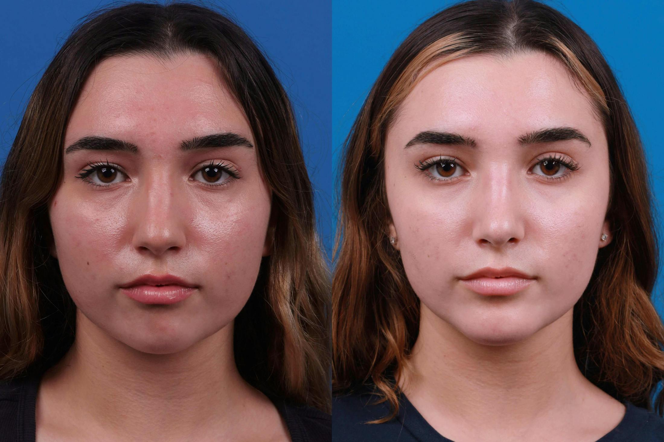 Rhinoplasty Before & After Gallery - Patient 122406980 - Image 1