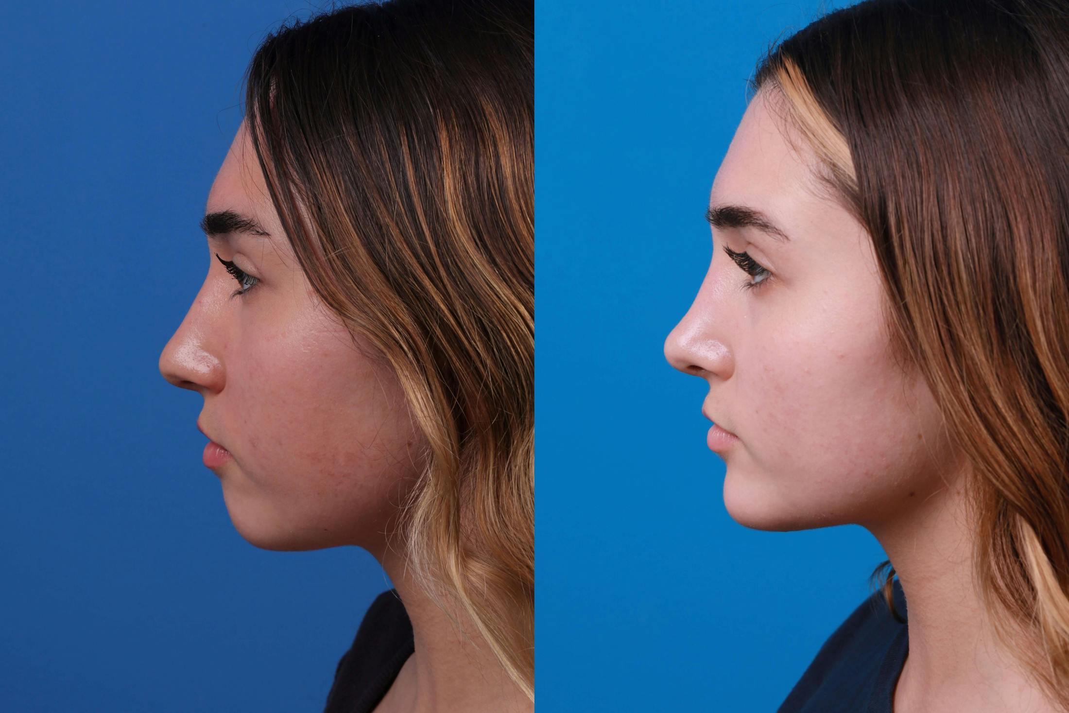 Rhinoplasty Before & After Gallery - Patient 122406980 - Image 2