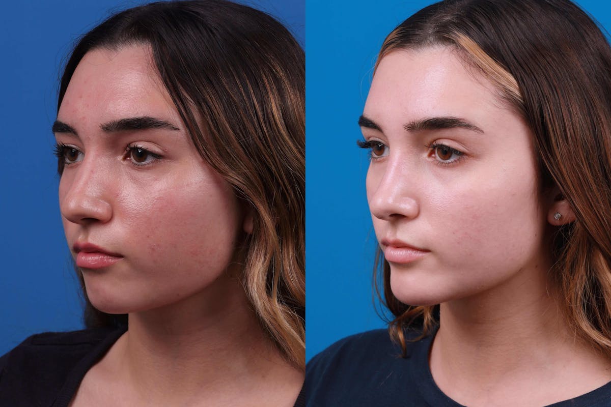 Rhinoplasty Before & After Gallery - Patient 122406980 - Image 3