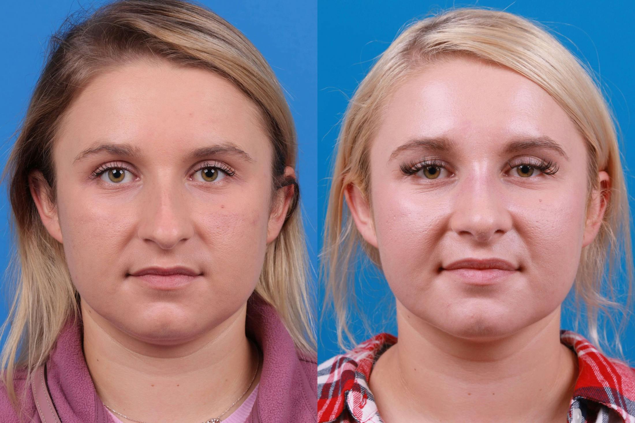 Rhinoplasty Before & After Gallery - Patient 122406981 - Image 1