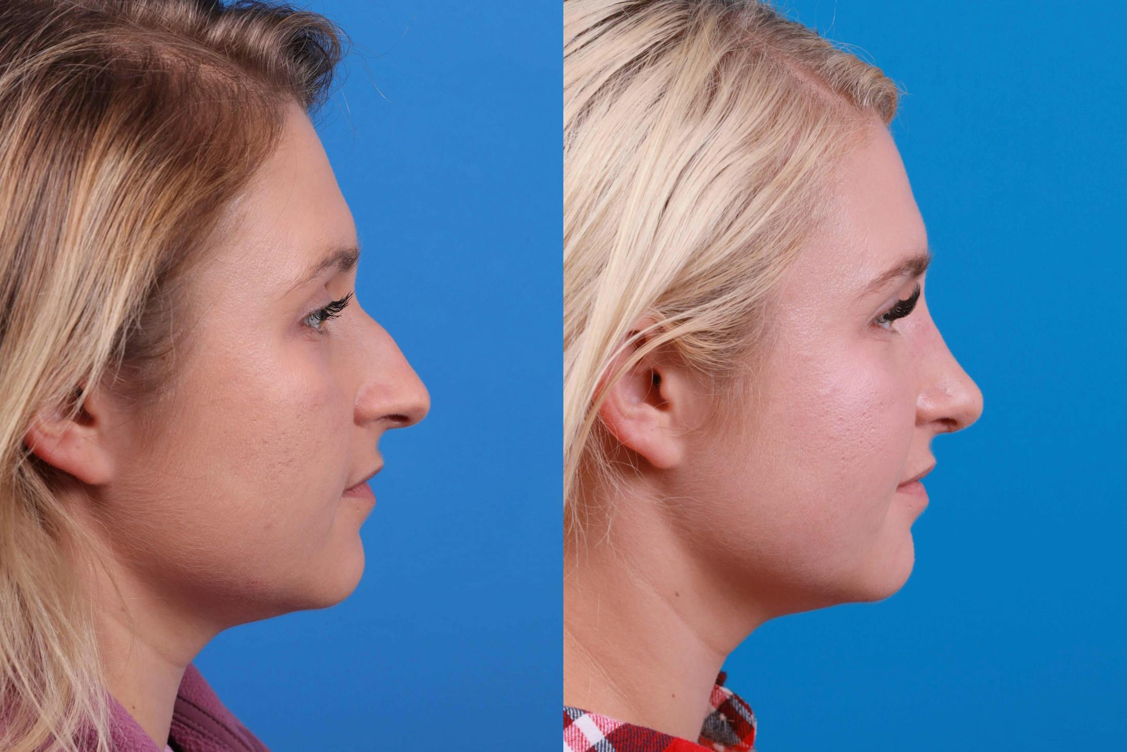 Rhinoplasty Before & After Gallery - Patient 122406981 - Image 2