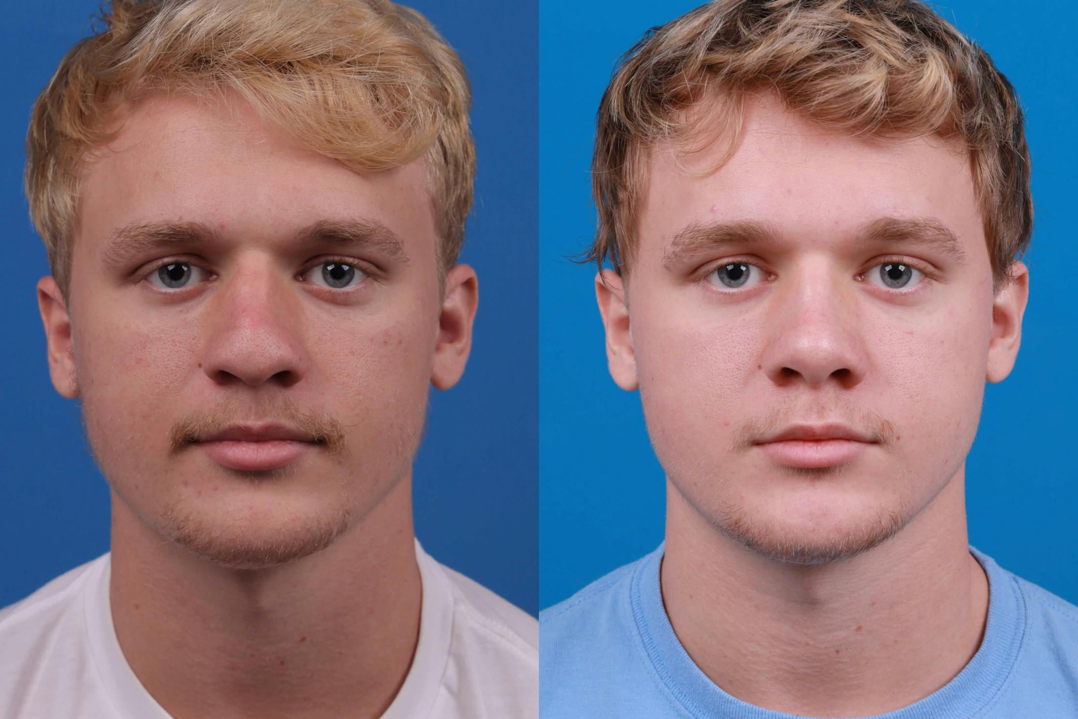 Rhinoplasty Before & After Gallery - Patient 122406982 - Image 1