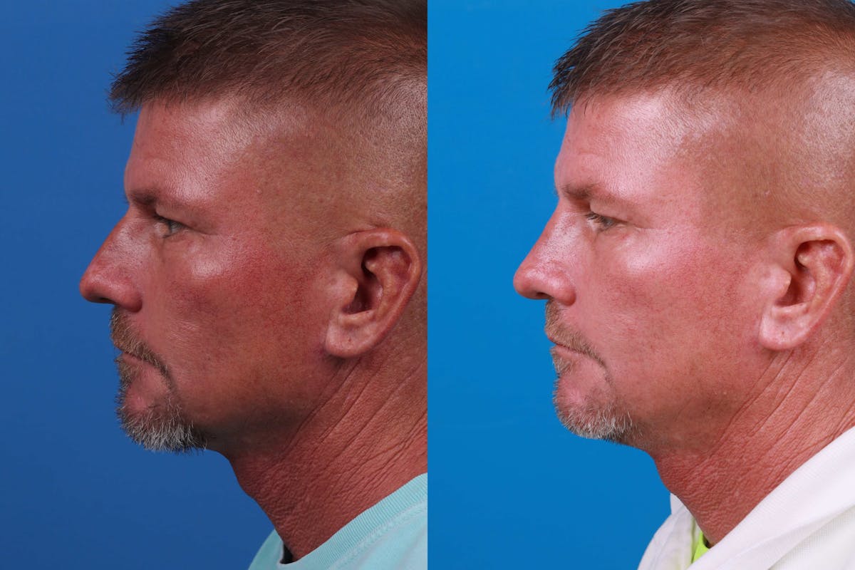 Rhinoplasty Before & After Gallery - Patient 122406983 - Image 2