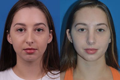 Rhinoplasty Before & After Gallery - Patient 122406984 - Image 1