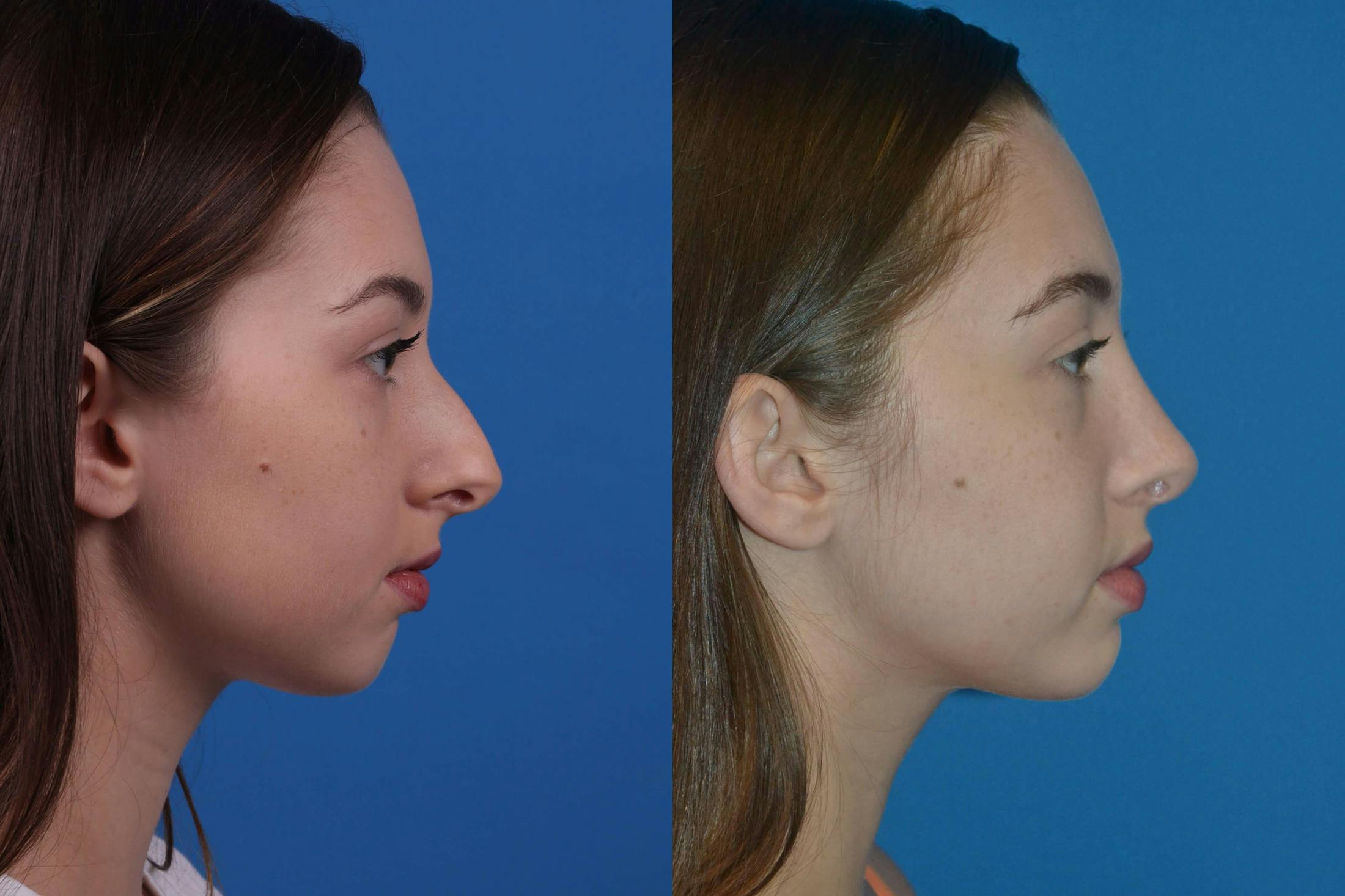 Rhinoplasty Before & After Gallery - Patient 122406984 - Image 2