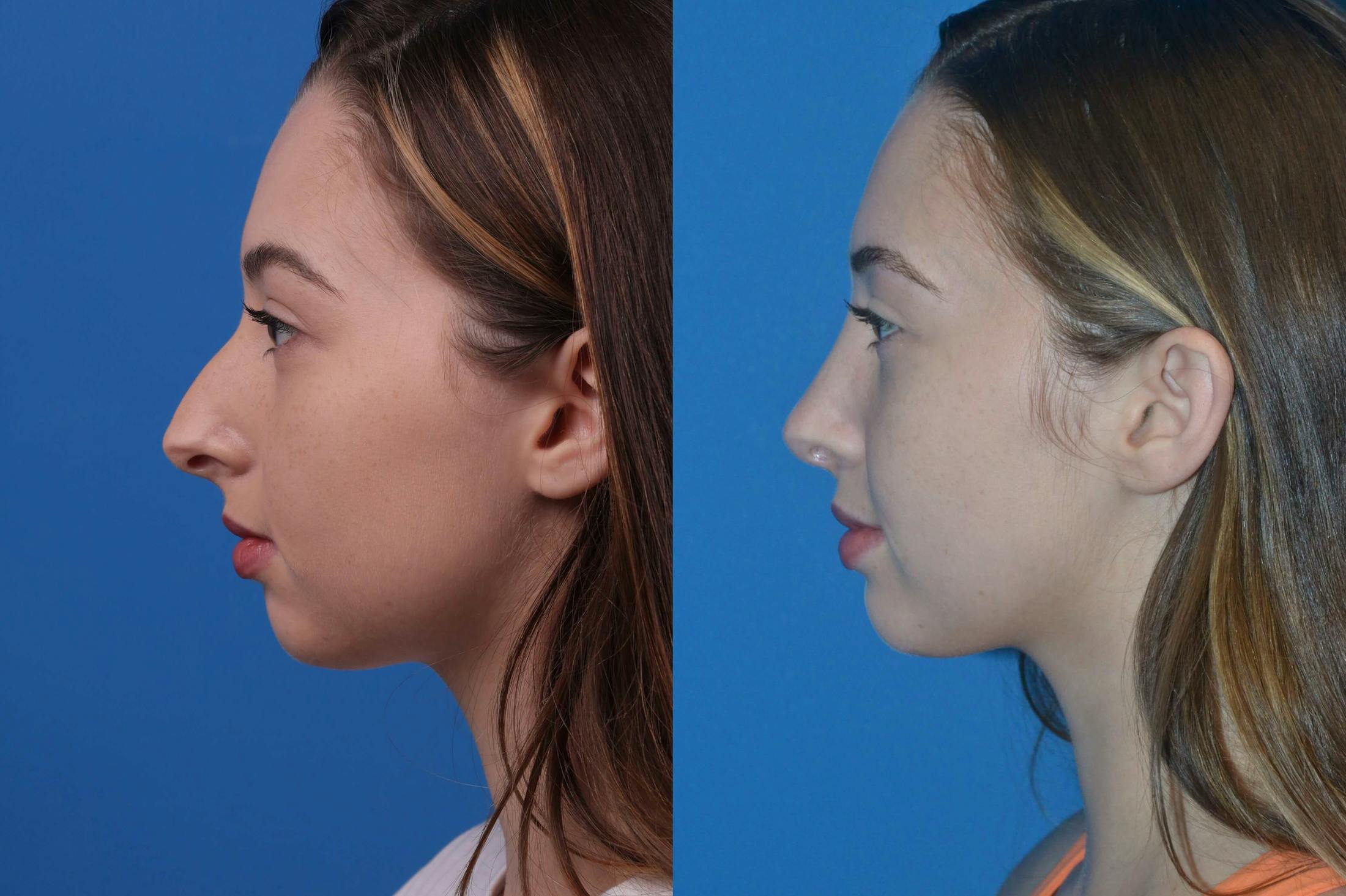 Rhinoplasty Before & After Gallery - Patient 122406984 - Image 3