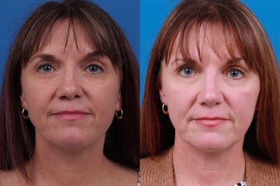 Rhinoplasty Before & After Gallery - Patient 122406986 - Image 1