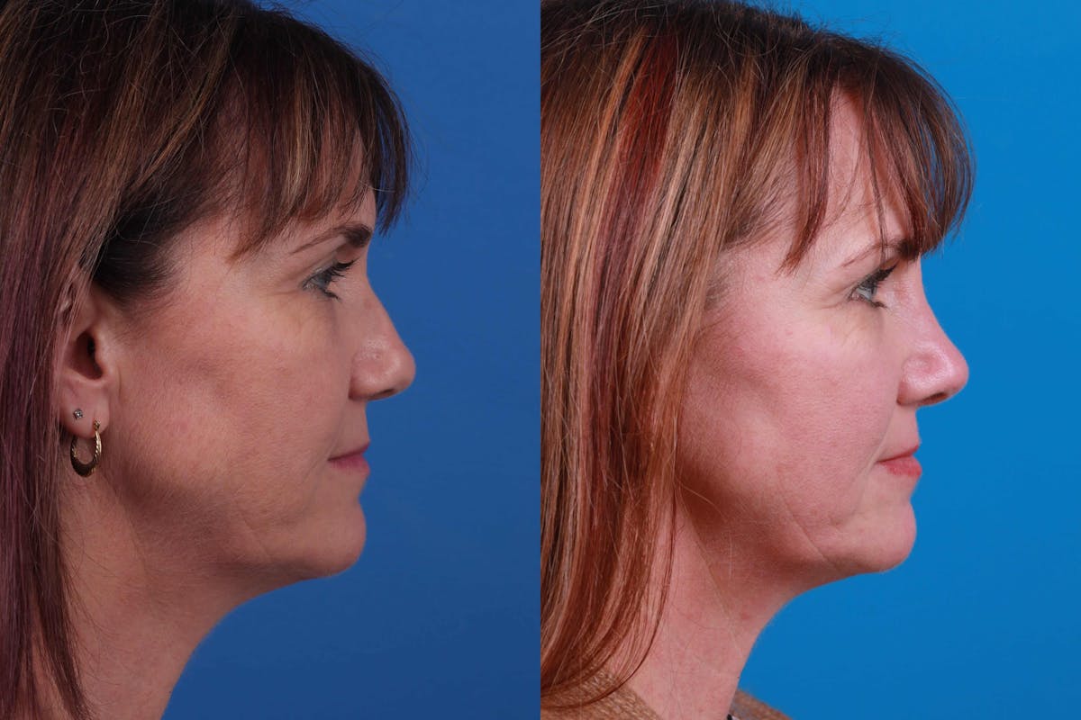 Rhinoplasty Before & After Gallery - Patient 122406986 - Image 2