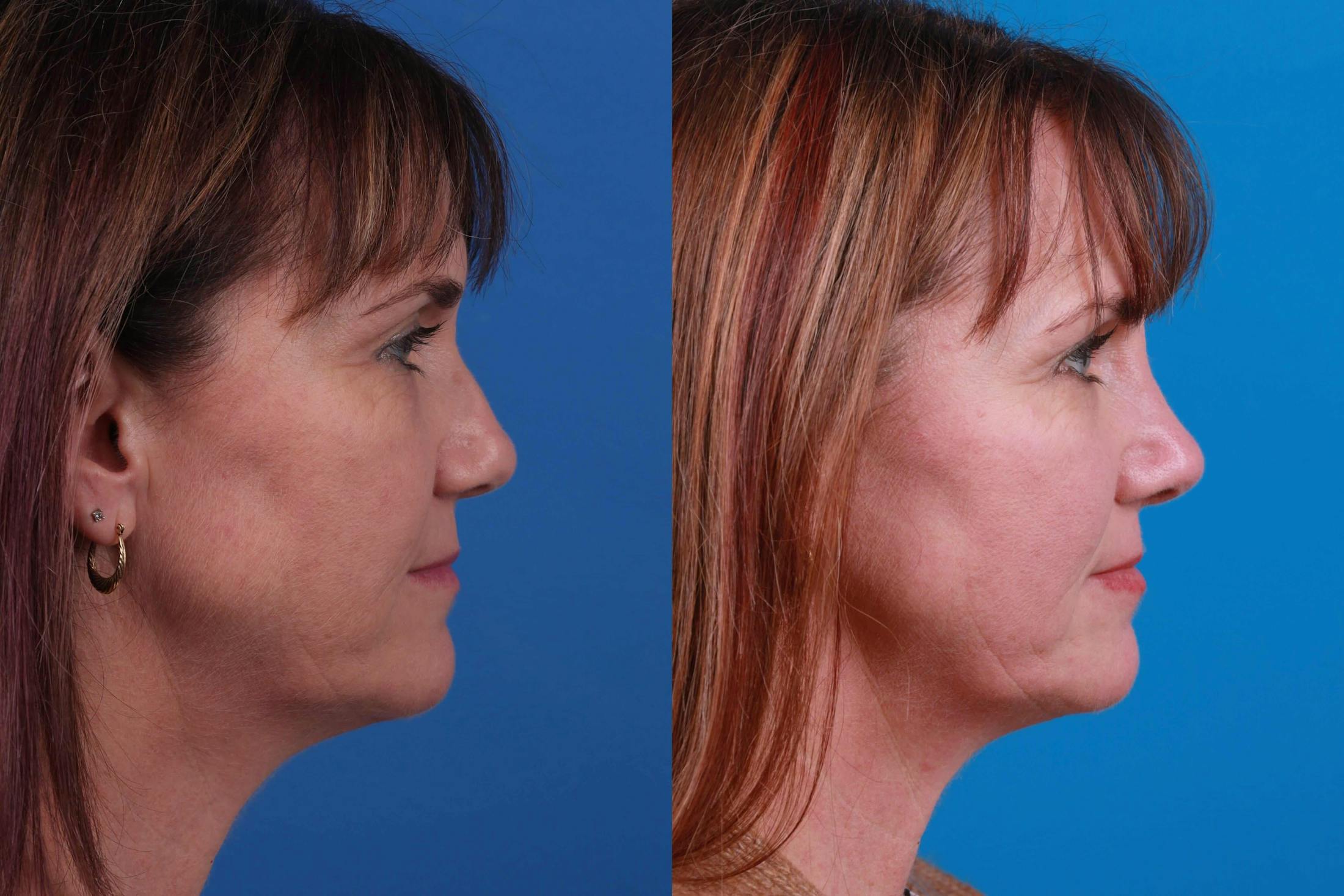Rhinoplasty Before & After Gallery - Patient 122406986 - Image 2