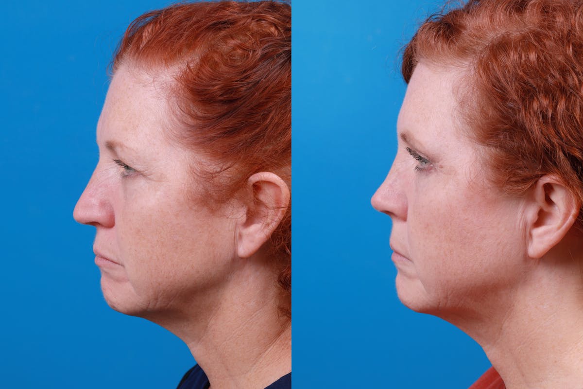 Rhinoplasty Before & After Gallery - Patient 122406989 - Image 1