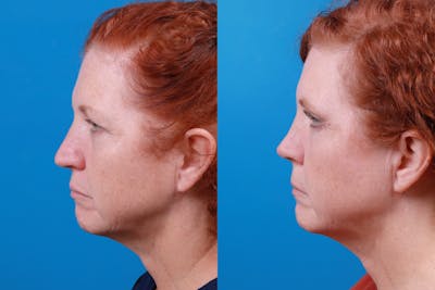 Rhinoplasty Before & After Gallery - Patient 122406989 - Image 1