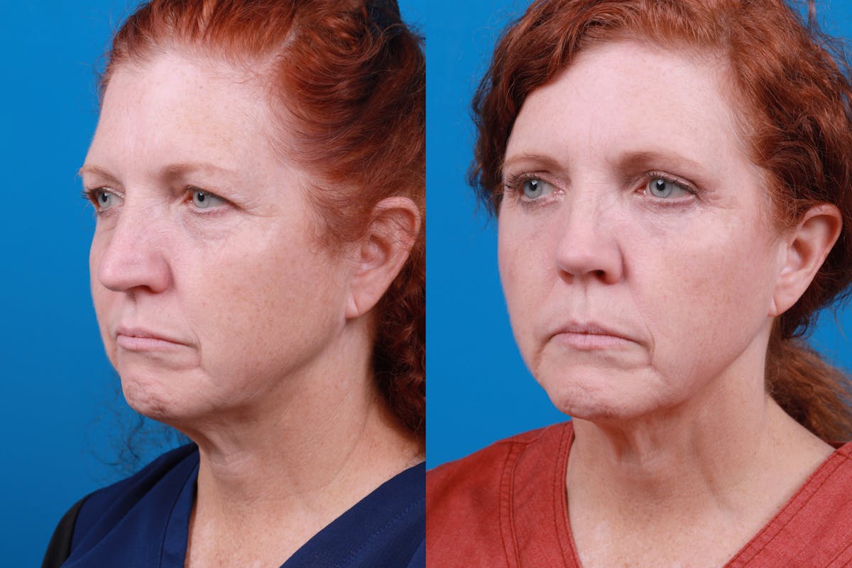 Rhinoplasty Before & After Gallery - Patient 122406989 - Image 2