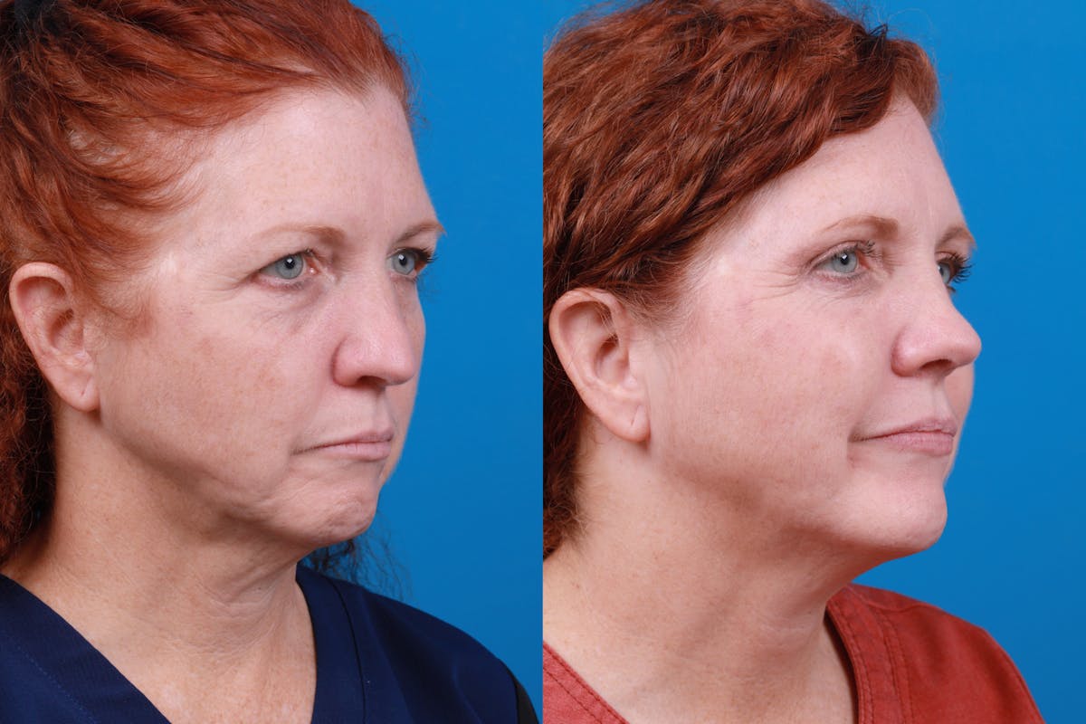 Rhinoplasty Before & After Gallery - Patient 122406989 - Image 4