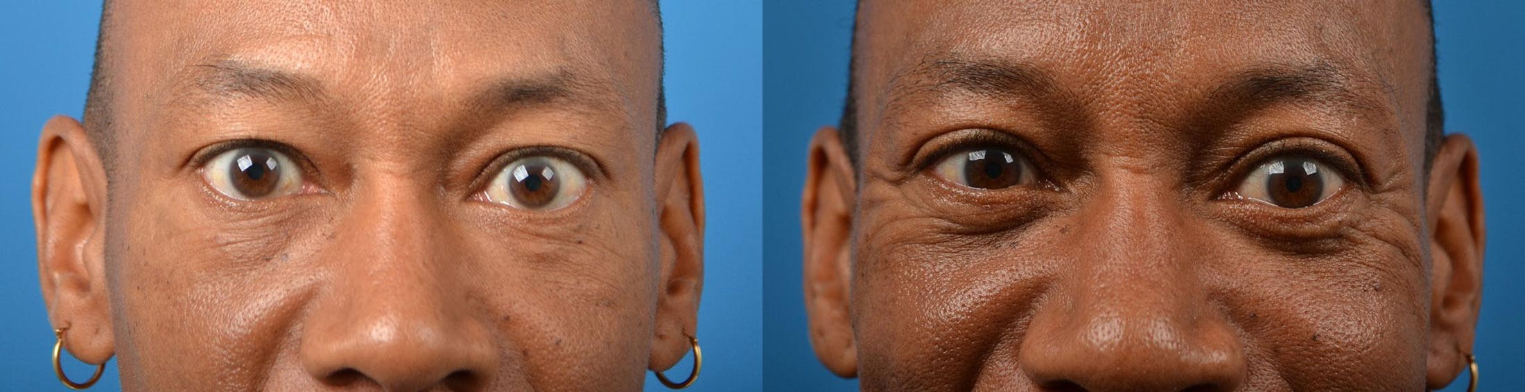 Eyelid Surgery Gallery - Patient 122444546 - Image 1