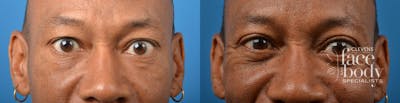 Eyelid Surgery Before & After Gallery - Patient 252136 - Image 1