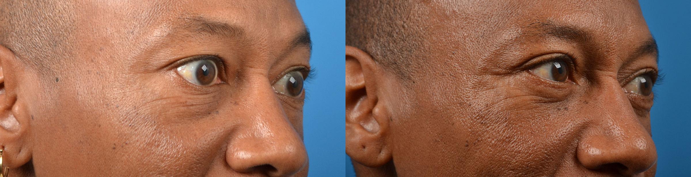 Eyelid Surgery Before & After Gallery - Patient 252136 - Image 2