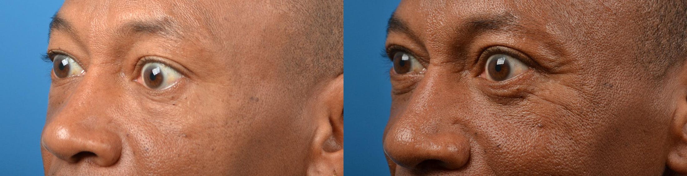 Eyelid Surgery Gallery - Patient 122444546 - Image 3
