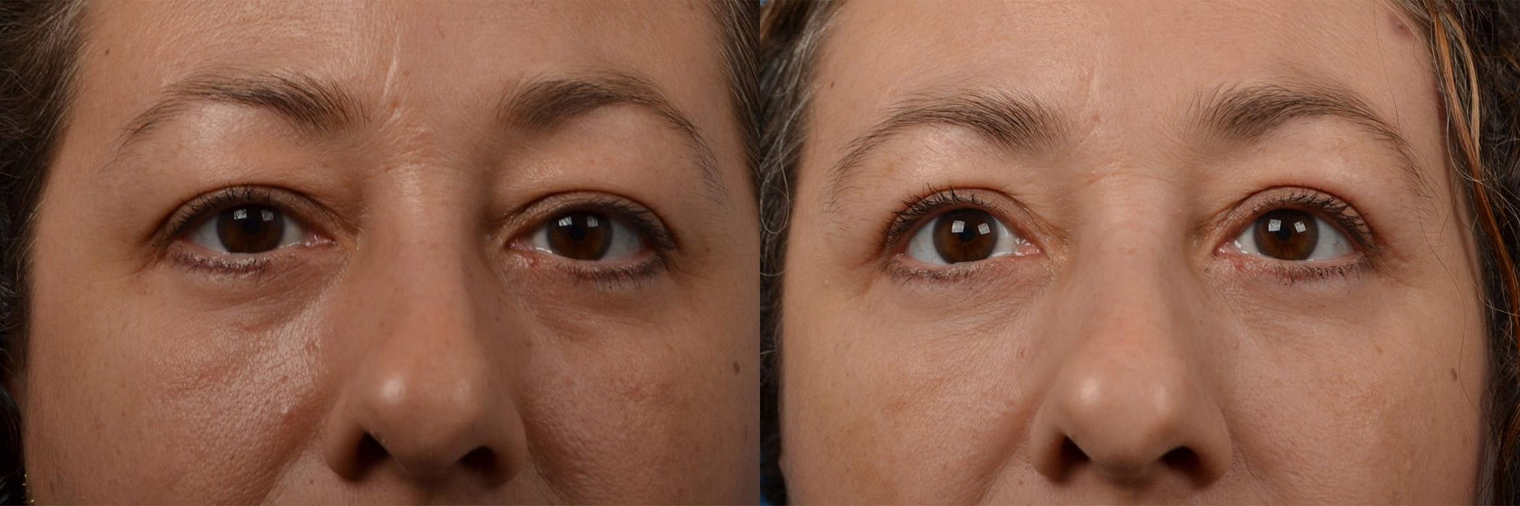 Eyelid Surgery Before & After Gallery - Patient 122444552 - Image 1
