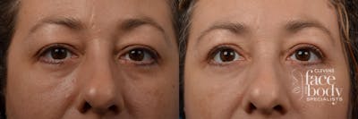 Eyelid Surgery Before & After Gallery - Patient 184933 - Image 1