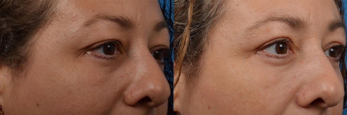 Eyelid Surgery Before & After Gallery - Patient 122444552 - Image 2