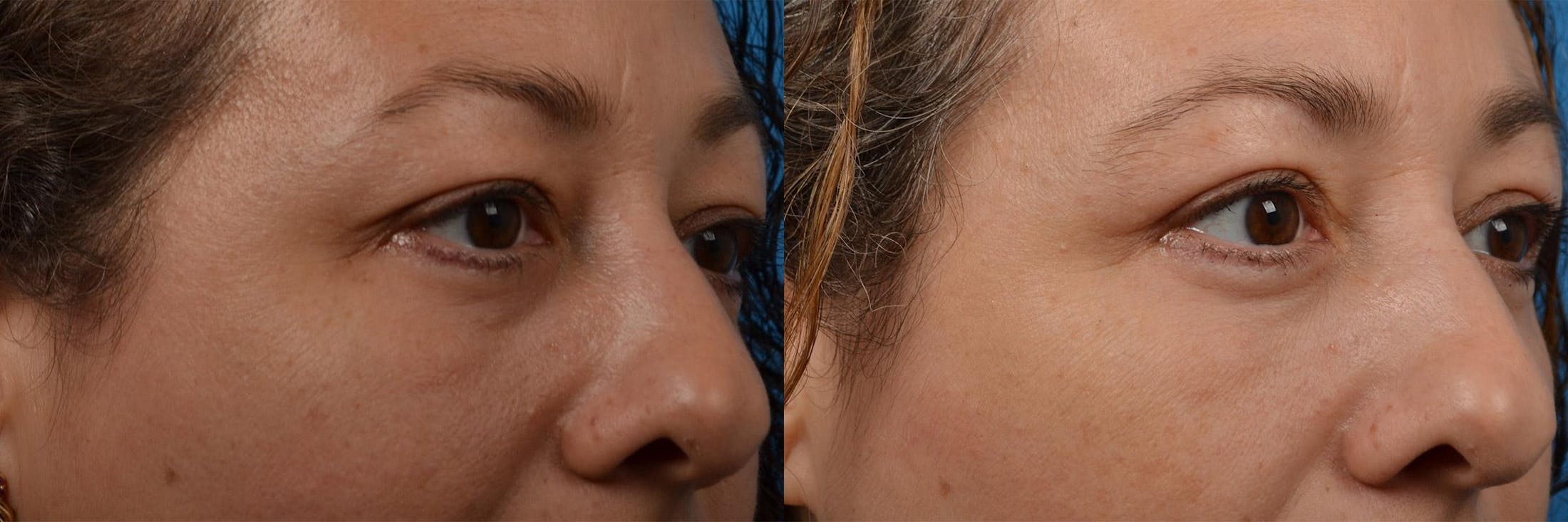 Eyelid Surgery Before & After Gallery - Patient 122444552 - Image 2