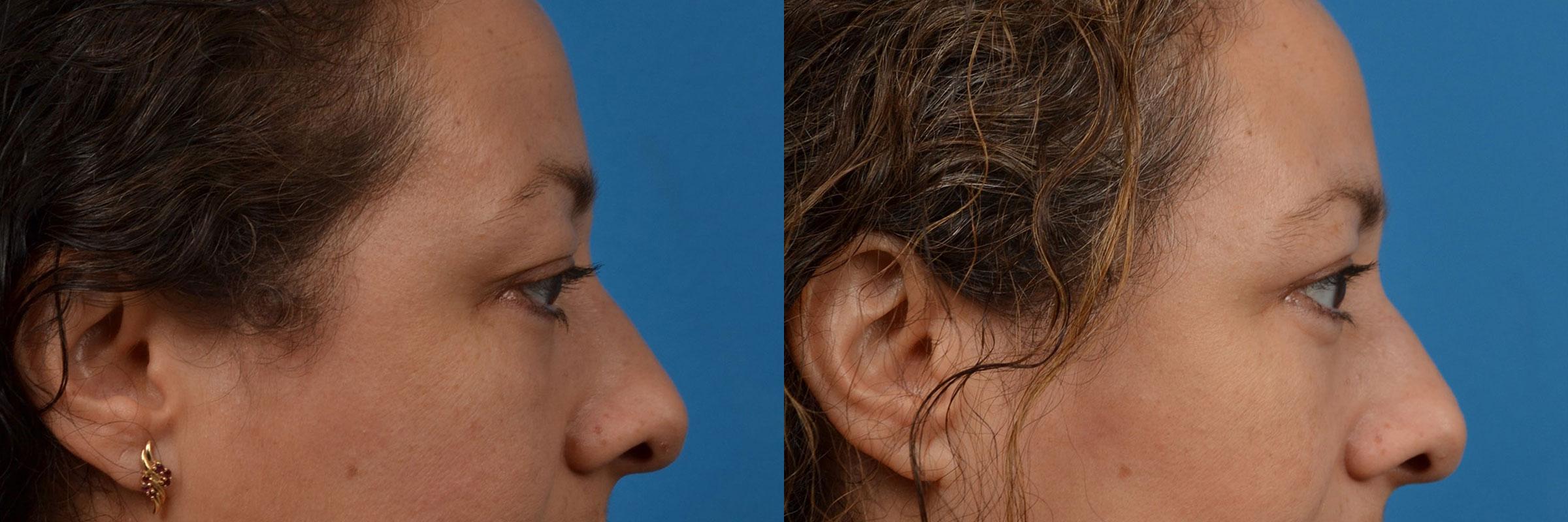 Eyelid Surgery Before & After Gallery - Patient 184933 - Image 3