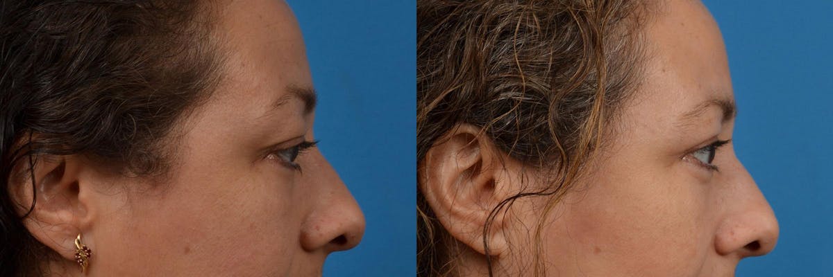 Eyelid Surgery Before & After Gallery - Patient 122444552 - Image 3