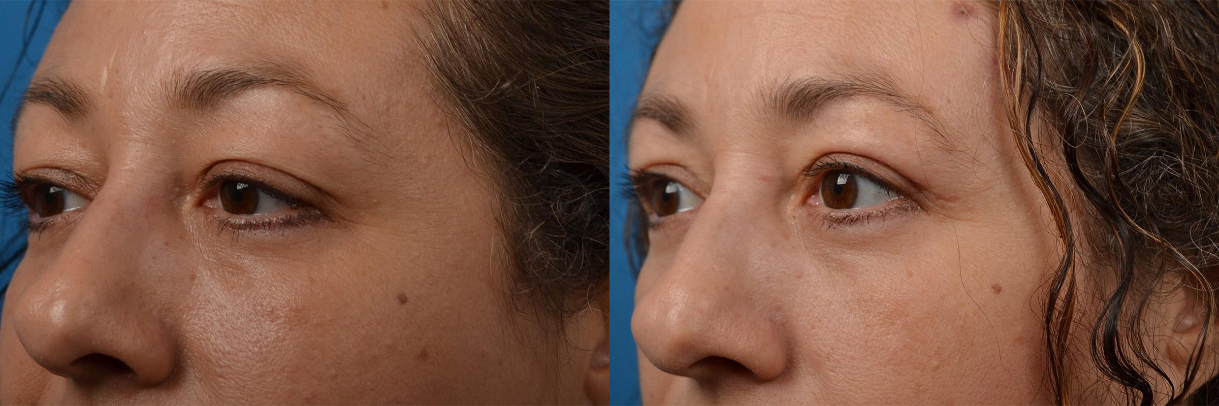 Eyelid Surgery Before & After Gallery - Patient 184933 - Image 4