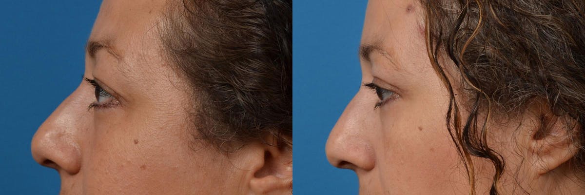 Eyelid Surgery Before & After Gallery - Patient 122444552 - Image 5
