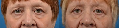 Eyelid Surgery Before & After Gallery - Patient 122444555 - Image 1