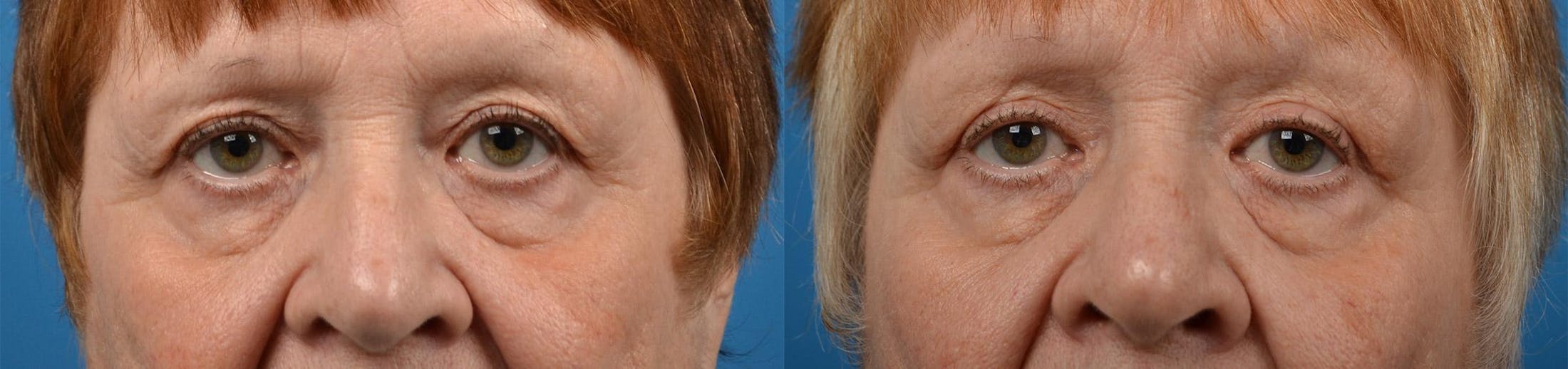 Eyelid Surgery Before & After Gallery - Patient 122444555 - Image 1