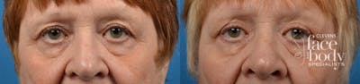 Eyelid Surgery Before & After Gallery - Patient 207469 - Image 1
