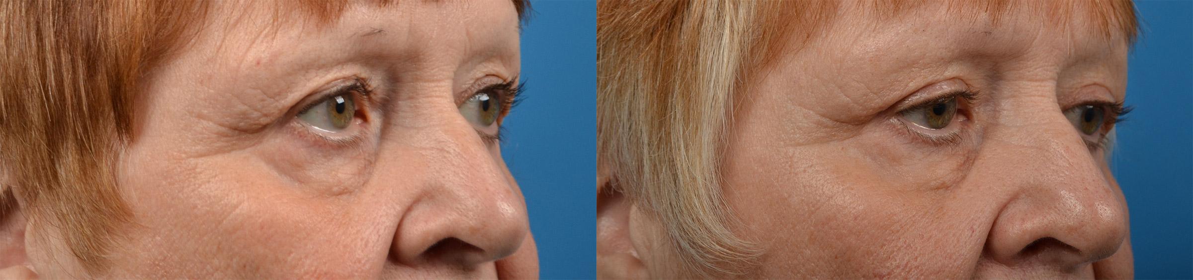Eyelid Surgery Before & After Gallery - Patient 207469 - Image 2