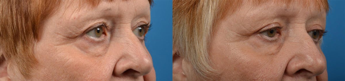 Eyelid Surgery Before & After Gallery - Patient 122444555 - Image 2